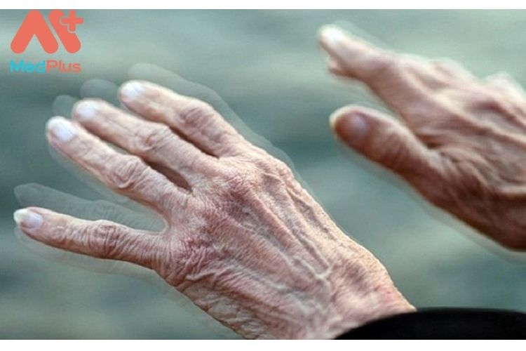 Bảo hiểm bệnh hiểm nghèo cho bệnh Parkinson và 4 điều cơ bản