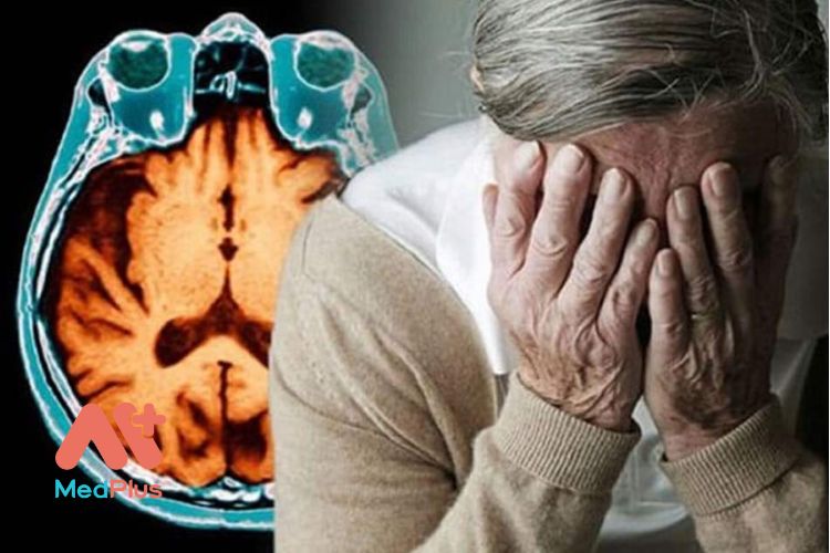 Bệnh Alzheimer là bệnh hiểm nghèo được bảo hiểm