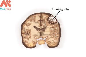 5 điều cần biết khi mắc bệnh u mãng não mua Bảo hiểm sức khỏe Bảo Việt An Gia