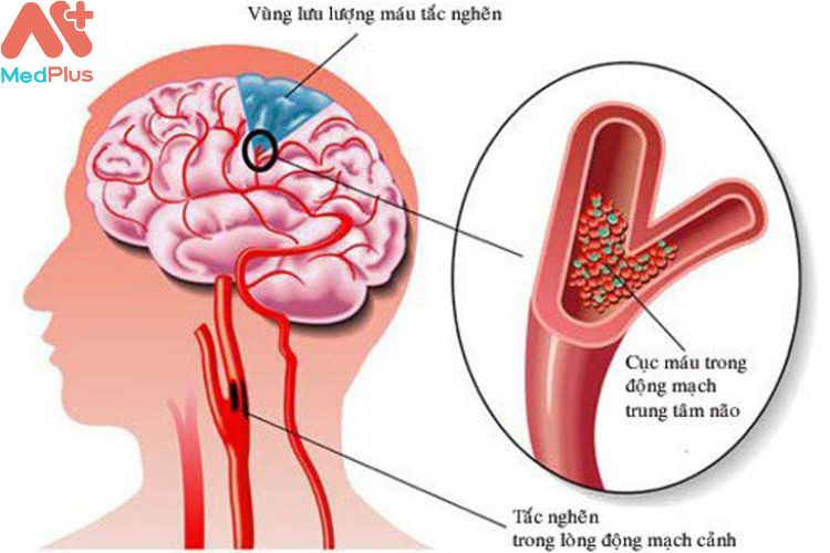 Bệnh nhồi máu não