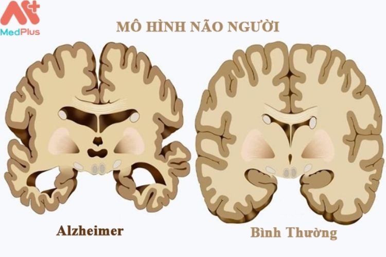 Bệnh Alzheimer’s (AHLZ-high-merz) là một bệnh lý về não tác động đến trí nhớ