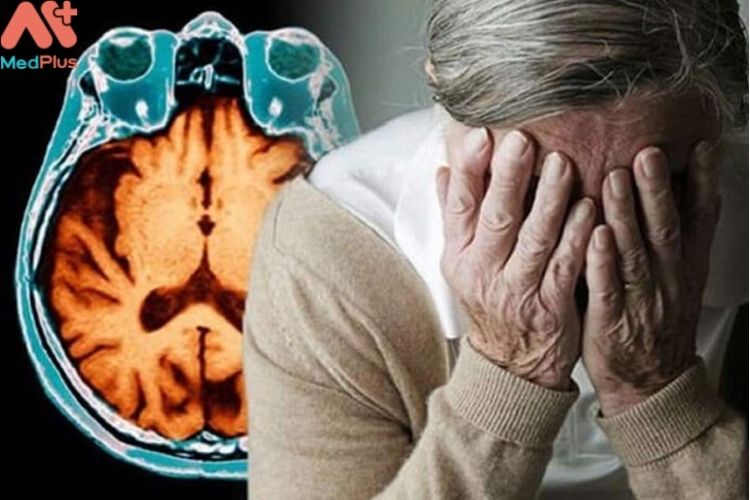 Cách phòng ngừa bệnh Alzheimer từ sớm