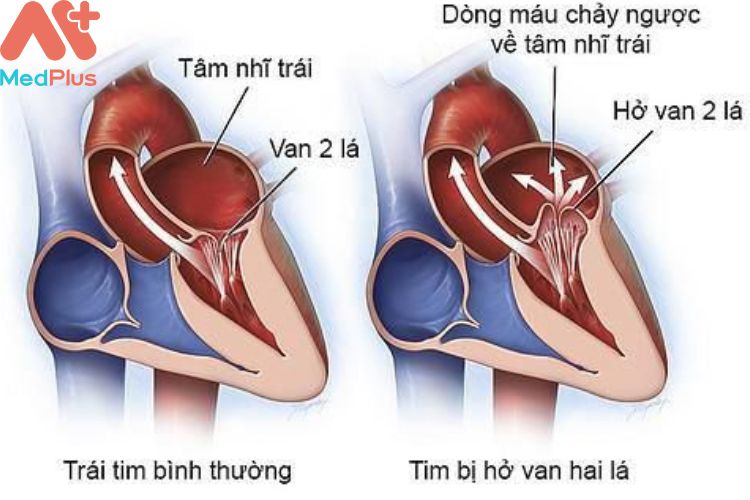 Bệnh Hở van 2 lá là gì?