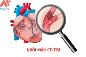 Bệnh nhồi máu cơ tim mua bảo hiểm sức khỏe Bảo Việt An Gia được không