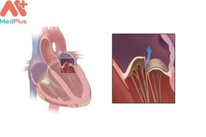 Bệnh sa van 2 lá mua bảo hiểm sức khỏe Bảo Việt An Gia được không?