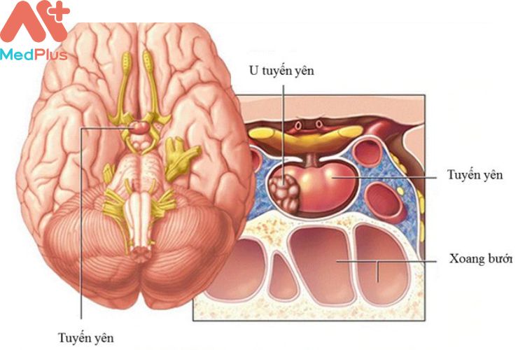 Bệnh u tuyến yên mua bảo hiểm sức khỏe bảo việt an gia