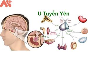 Bệnh u tuyến yên mua bảo hiểm sức khỏe Bảo Việt An Gia và 4 điều cần biết