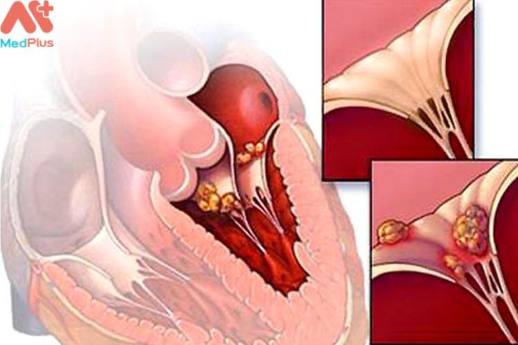 Đứt dây chằng van 2 có phải nguyên nhân gây hở van 2 lá