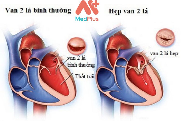 Hẹp van 2 lá mua bảo hiểm sức khỏe bảo việt an gia