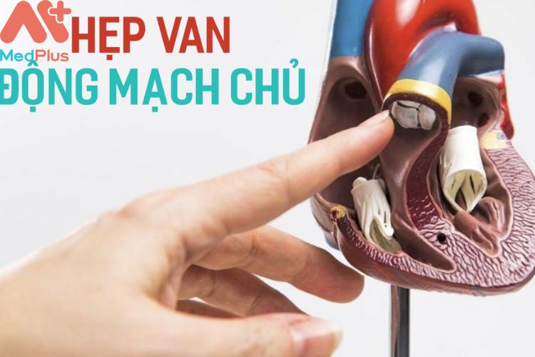 Hẹp van động mạch chủ mua bảo hiểm sứ khỏe bảo việt an gia