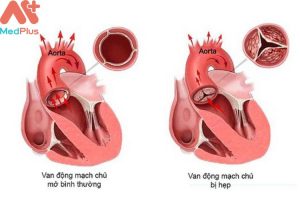 Hẹp van động mạch chủ mua bảo hiểm sức khỏe Bảo Việt An Gia có được không?