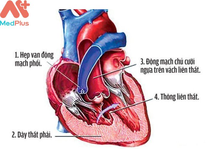 Hẹp van động mạch phổi mua bảo hiểm sức khỏe bảo việt an gia