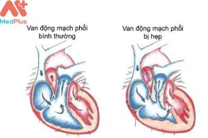 Hẹp van động mạch phổi mua bảo hiểm sức khỏe Bảo Việt An Gia có được không
