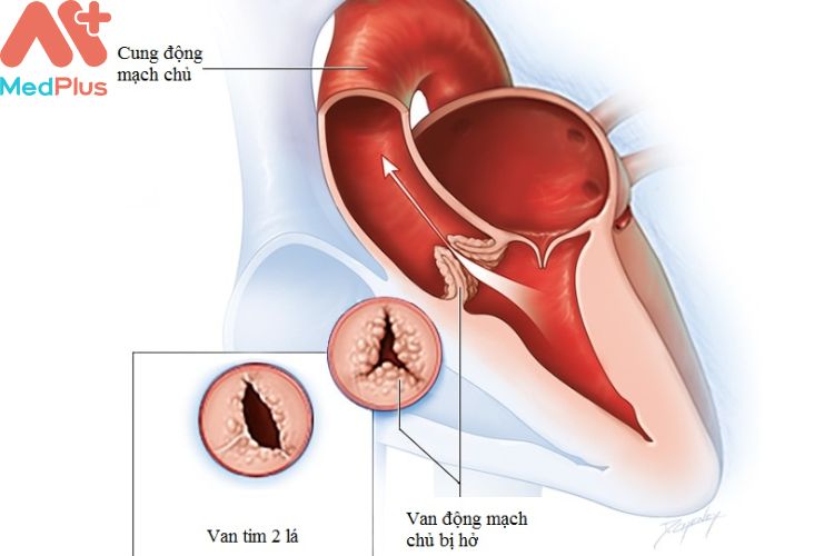 Hở van động mạch chủ mua bảo hiểm sức khỏe bảo việt an gia