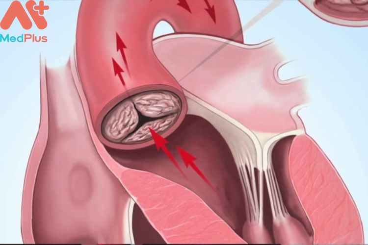 Hở van động mạch phổi mua bảo hiểm sức khỏe bảo việt an gia