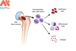 Hội chứng loạn sản tủy xương mua Bảo hiểm sức khỏe Bảo Việt An Gia có được không?