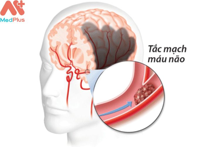 Nghẽn tắc và hẹp động mạch não