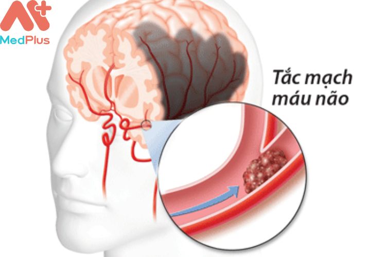 Nguyên nhân gây Nghẽn tắc và hẹp động mạch não