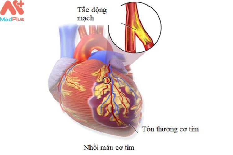 Nhồi cáu cơ tim cấp là gì?