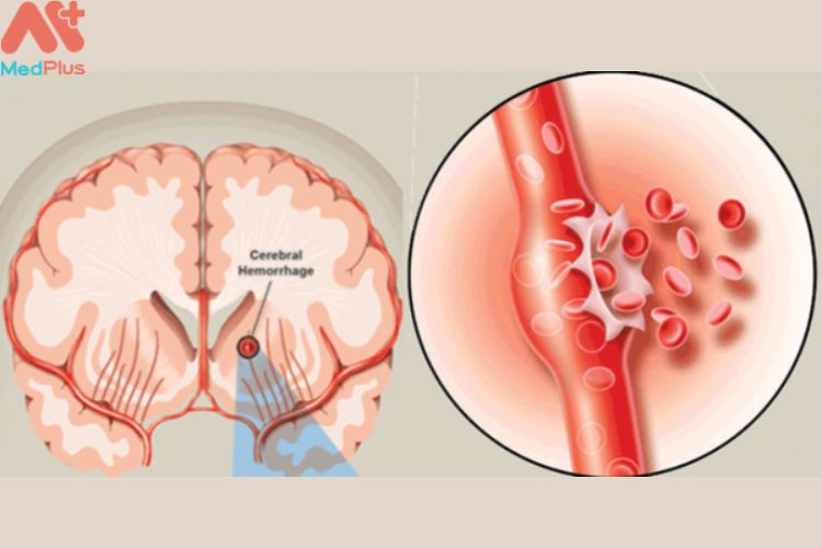 biến chứng khó lường như xuất huyết não