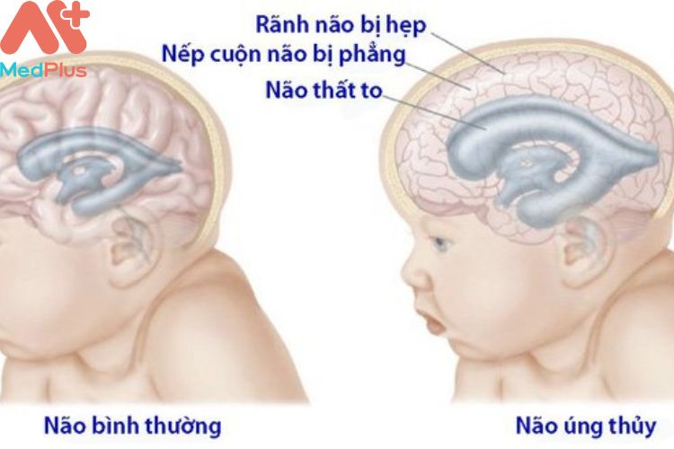 Tràn dịch não là gì