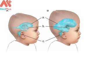 Tràn dịch não thất mua Bảo hiểm sức khỏe Bảo Việt An Gia và 4 điều cần biết