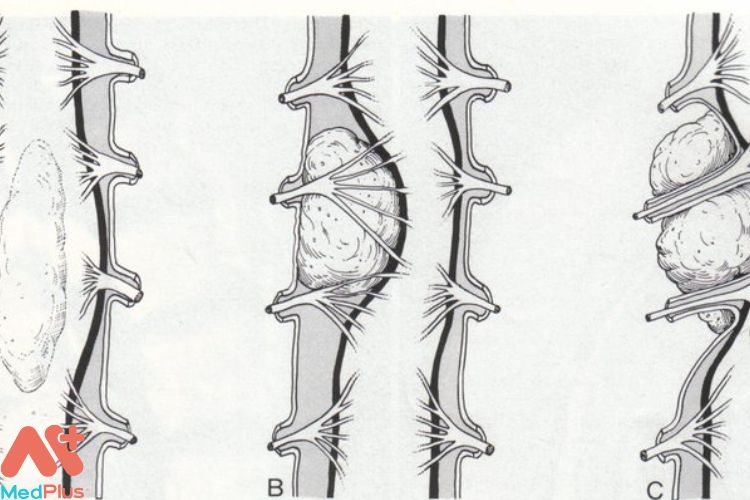 U ác ở tủy sống