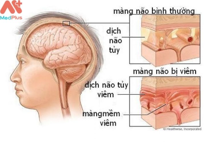 Viêm màng não trong do nấm là gì?