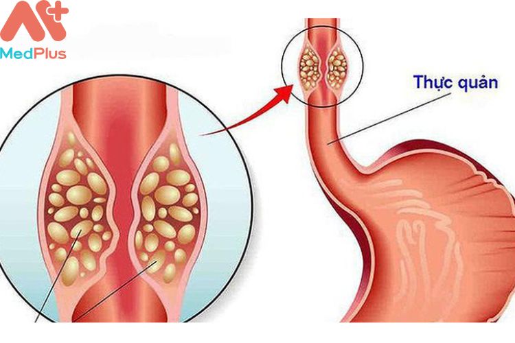 Viêm thực quản mua bảo hiểm sức khỏe bảo việt an gia