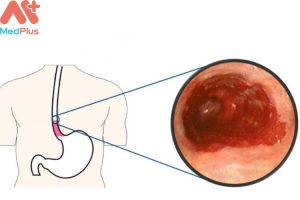 Viêm thực quản mua bảo hiểm sức khỏe Bảo Việt An Gia được không?