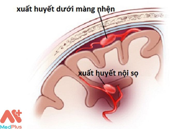 Điều trị xuất huyết nội sọ