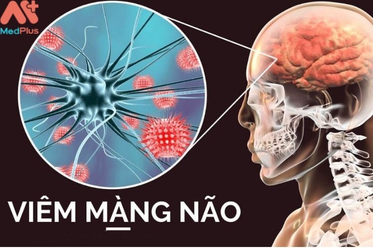 Viêm màng não do khuẩn Haemophilus