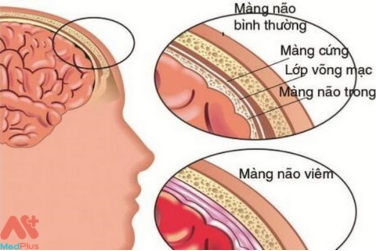 Viêm màng não do khuẩn Haemophilus