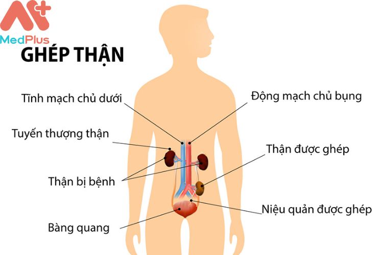 Ghép thận mua bảo hiểm sức khỏe Bảo Việt An Gia