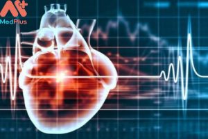 Rối loạn nhịp tim mua Bảo hiểm sức khỏe Bảo Việt An Gia có được chấp nhận không?