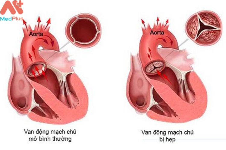 Teo động mạch chủ 