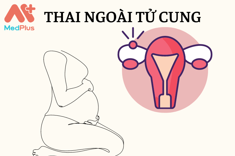 Thai-ngoai-tu-cung.png