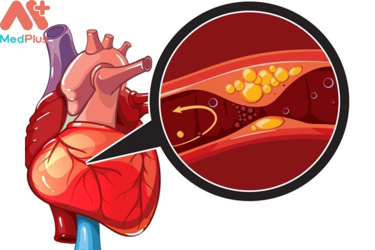 Thiếu máu cơ tim mua bảo hiểm sức khỏe Bảo Việt An Gia