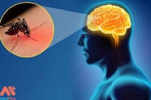 Viêm não virus do muỗi mua bảo hiểm sức khỏe Bảo Việt An Gia