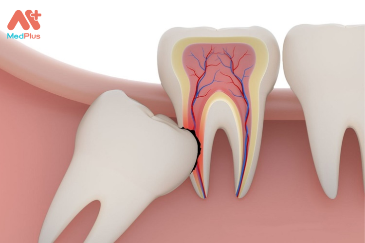 Răng khôn bị va đập