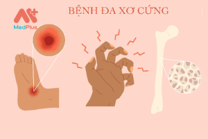 Bệnh đa xơ cứng là gì?