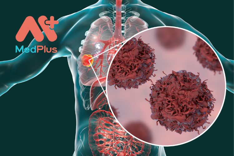 Ung thư là căn bệnh nguy hiểm và là nguyên nhân gây tử vong hàng đầu tại Việt Nam